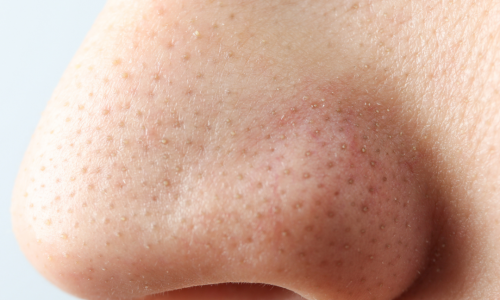 Cilt Temizliği ve Akneli Ciltler İçin En İyi Çözümler